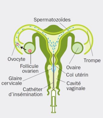 Les différentes techniques d'assistance médicale à la procréation ...